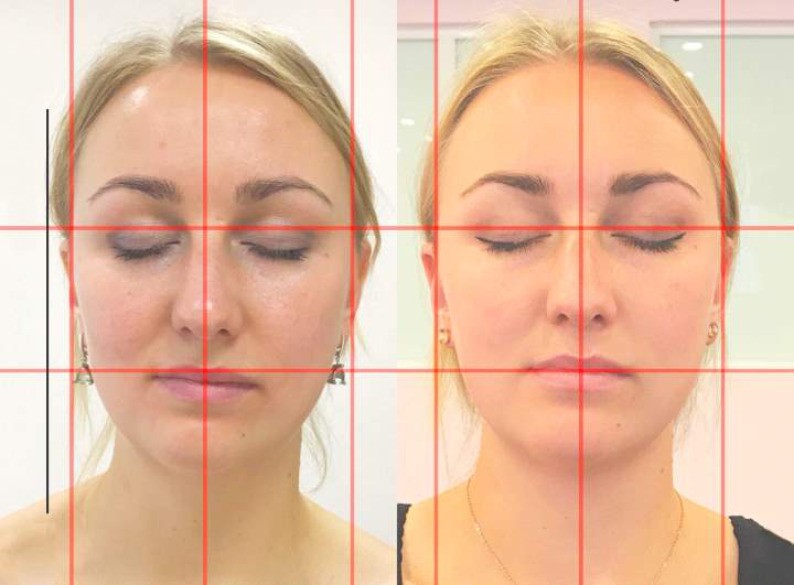 Кривошея У Грудничка Симптомы Фото Лечение — Фото Картинки