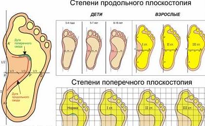 Реферат: Профілактика і лікування плоскостопості у дітей