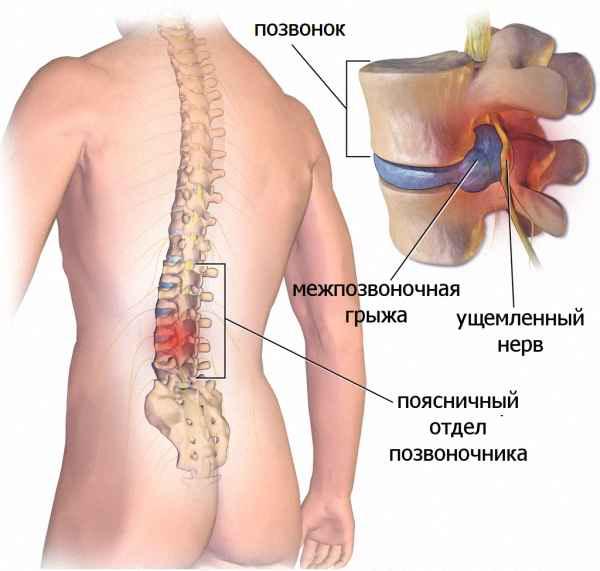 Болит поясница справа мышцы thumbnail