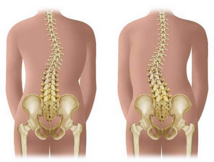 Кифосколиоз позвоночника в грудном отделе проявление и методы избавления