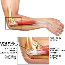 Болит локоть - причины и лечение боли в локтевом суставе | боль в локтевом суставе