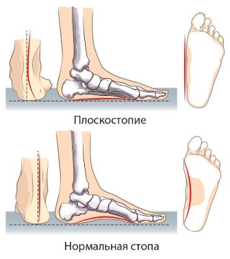 Почему болит пятка при наступании | Клиника «Здравствуй»