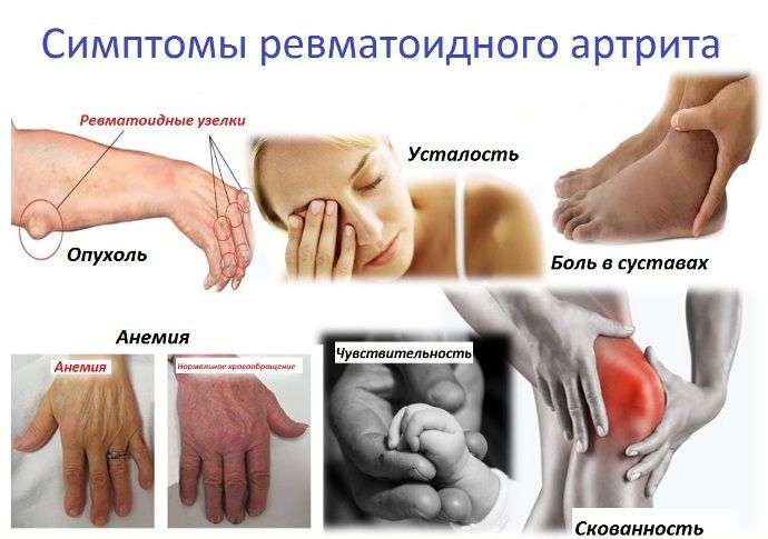 Какой артрит серопозитивный или серонегативный легче лечить. Серонегативный ревматоидный артрит: что это такое, симптомы и лечение Артрит Стопы Симптомы И Лечение Фото – Telegraph Артрит | ПРИЧИНЫ и эффективное ЛЕЧЕНИЕ артрита
