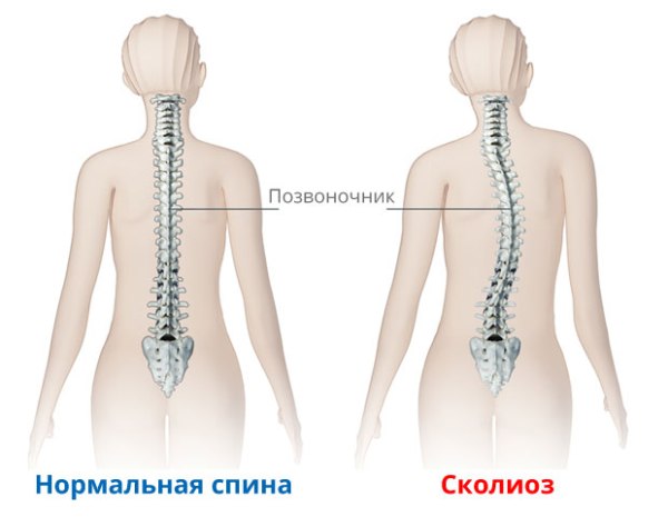 Индивидуальные занятия с ребенком инвалидом врожденный скалеоз